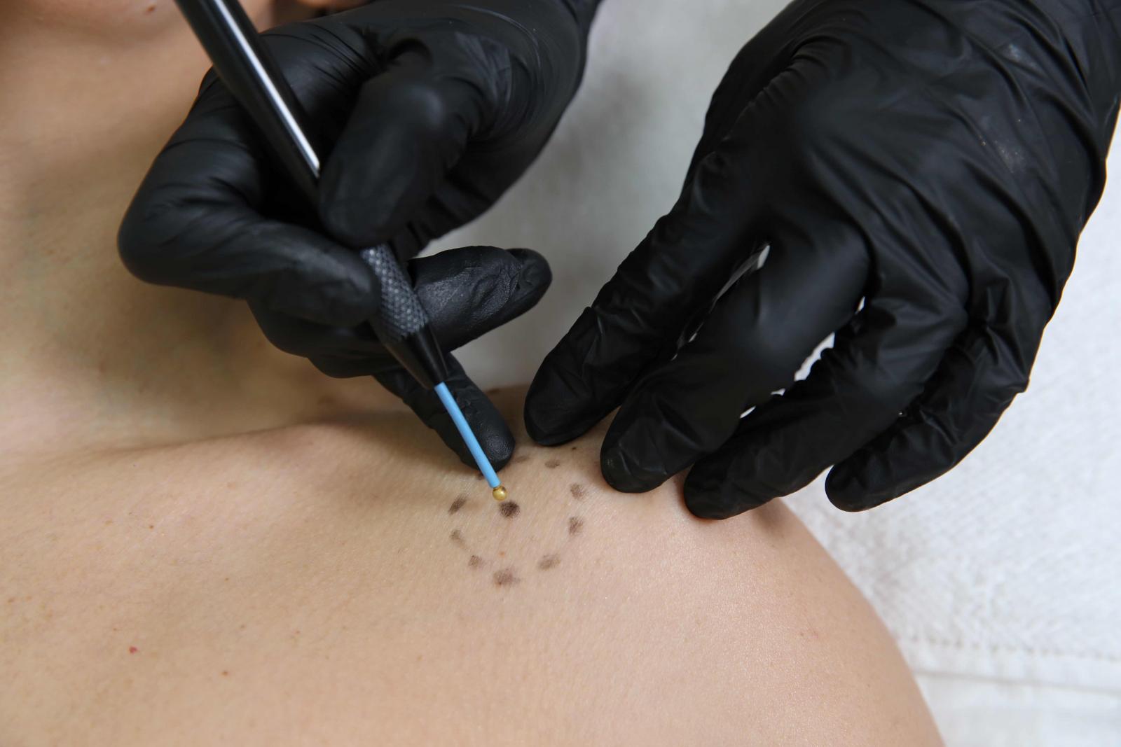 удаление родинки